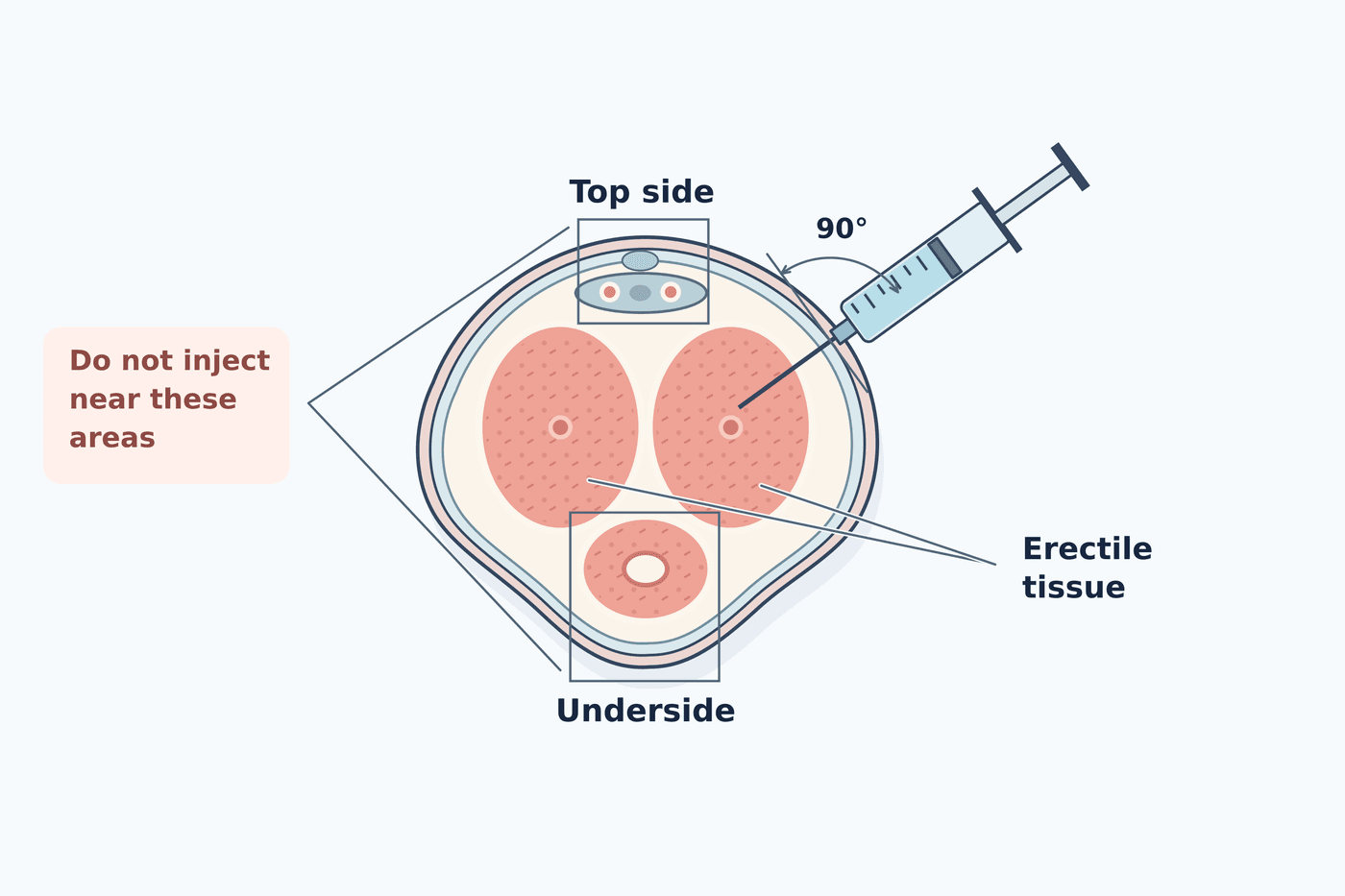 Illustration of penile injection therapy